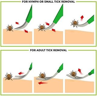 No. 1 - TickCheck Tick Remover Kit - 5